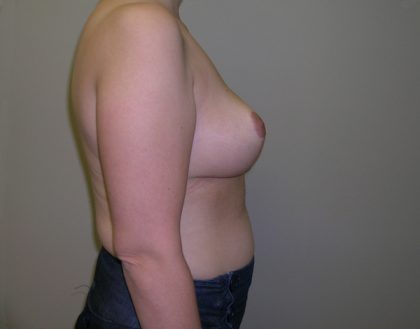 Breast Reduction Before & After Patient #926