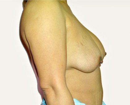 Breast Revision Before & After Patient #1052