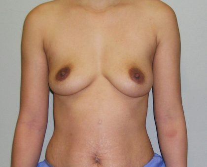 Breast Augmentation Before & After Patient #1607