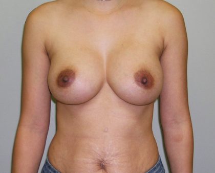 Breast Augmentation Before & After Patient #1607