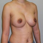Breast Augmentation Before & After Patient #1607