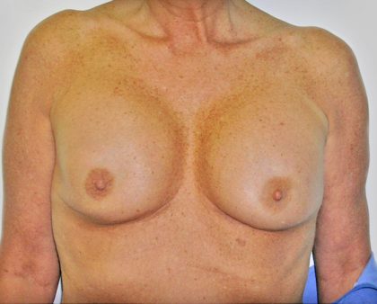 Breast Revision Before & After Patient #1059