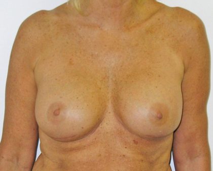 Breast Revision Before & After Patient #1059