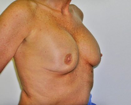 Breast Revision Before & After Patient #1059