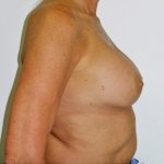 Breast Revision Before & After Patient #1059