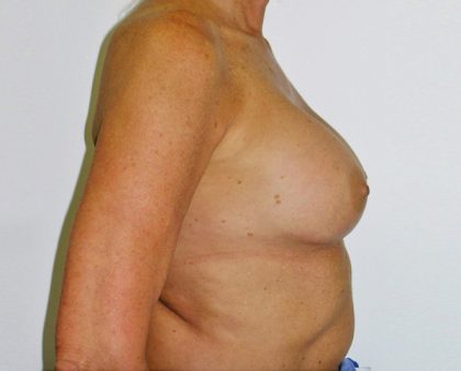 Breast Revision Before & After Patient #1059