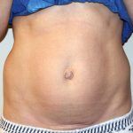 Tummy Tuck Before & After Patient #475