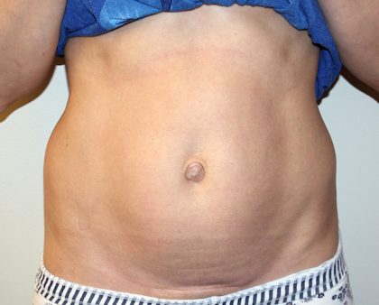 Tummy Tuck Before & After Patient #475