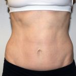 Tummy Tuck Before & After Patient #475