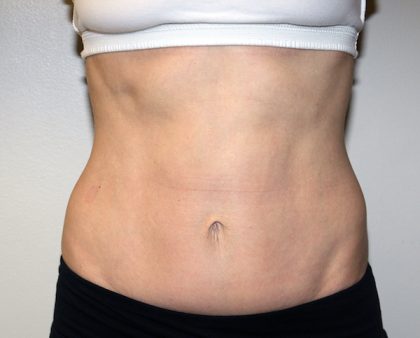 Tummy Tuck Before & After Patient #475