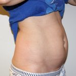 Tummy Tuck Before & After Patient #475