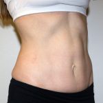 Tummy Tuck Before & After Patient #475