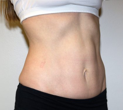 Tummy Tuck Before & After Patient #475