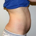 Tummy Tuck Before & After Patient #475