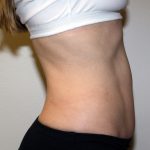 Tummy Tuck Before & After Patient #475