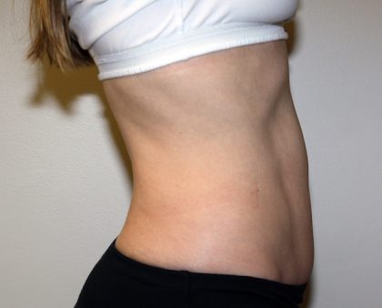 Tummy Tuck Before & After Patient #475