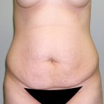 Tummy Tuck Before & After Patient #602