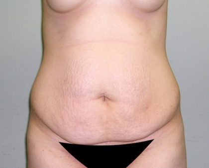 Tummy Tuck Before & After Patient #602