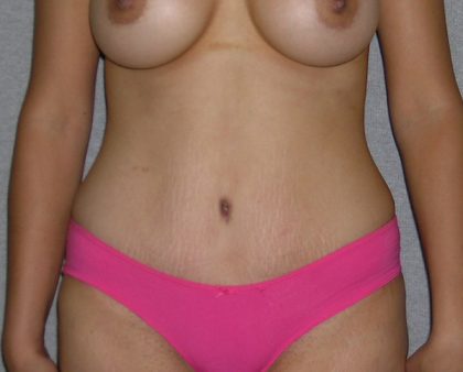 Tummy Tuck Before & After Patient #602