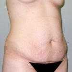 Tummy Tuck Before & After Patient #602