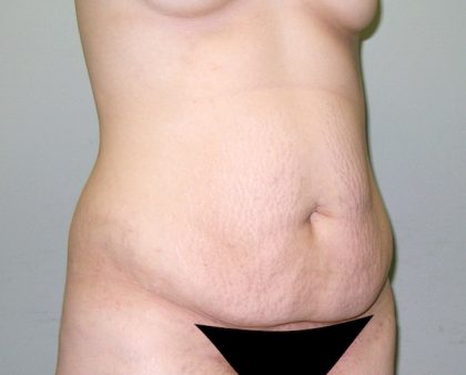 Tummy Tuck Before & After Patient #602