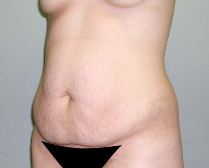 Tummy Tuck Before & After Patient #602