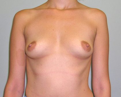 Breast Augmentation Before & After Patient #1500