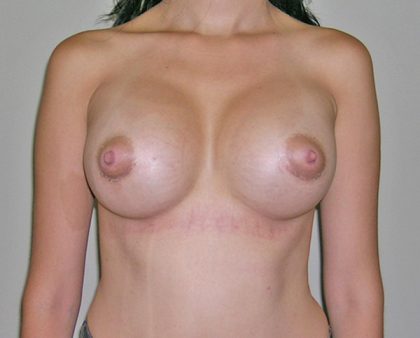 Breast Augmentation Before & After Patient #1500
