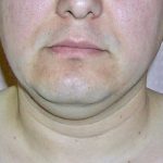 Neck Liposuction Before & After Patient #1148