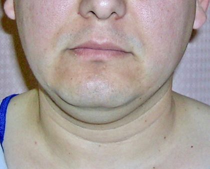 Neck Liposuction Before & After Patient #1148