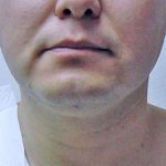 Neck Liposuction Before & After Patient #1148