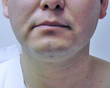 Neck Liposuction Before & After Patient #1148