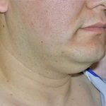 Neck Liposuction Before & After Patient #1148