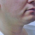 Neck Liposuction Before & After Patient #1148