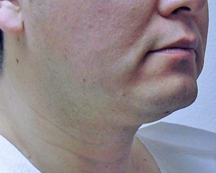 Neck Liposuction Before & After Patient #1148