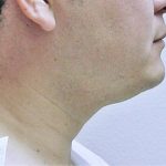 Neck Liposuction Before & After Patient #1148