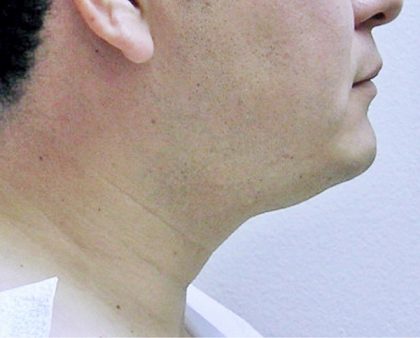 Neck Liposuction Before & After Patient #1148