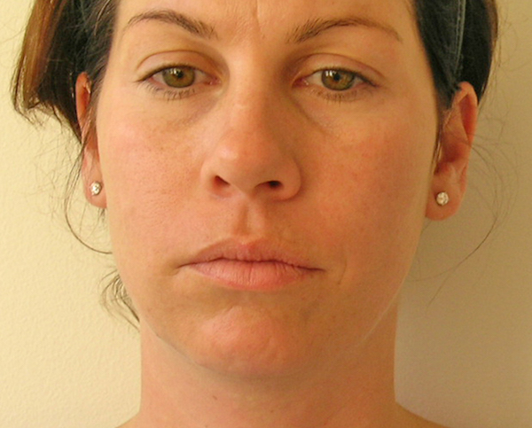 Liposuction Before & After Patient #1188