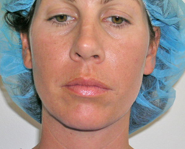 Liposuction Before & After Patient #1188