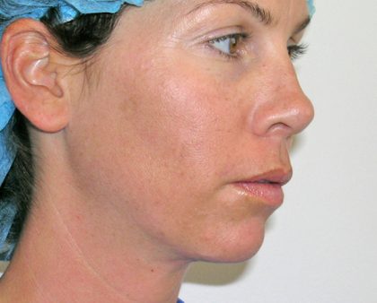 Neck Liposuction Before & After Patient #1188