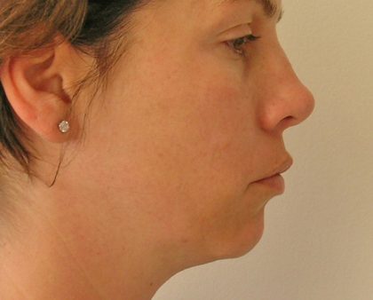 Neck Liposuction Before & After Patient #1188