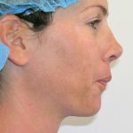 Neck Liposuction Before & After Patient #1188