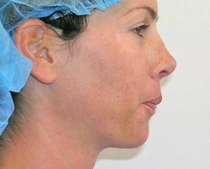 Neck Liposuction Before & After Patient #1188