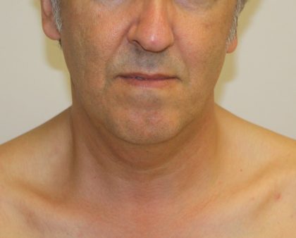 Neck Liposuction Before & After Patient #1213