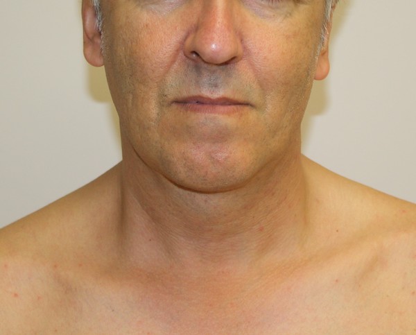 Liposuction Before & After Patient #1213