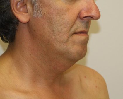 Neck Liposuction Before & After Patient #1213