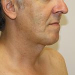 Neck Liposuction Before & After Patient #1213