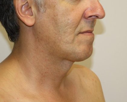 Neck Liposuction Before & After Patient #1213