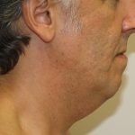 Neck Liposuction Before & After Patient #1213