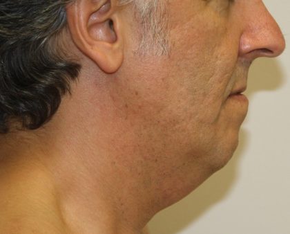 Neck Liposuction Before & After Patient #1213